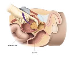 openprostatectomy