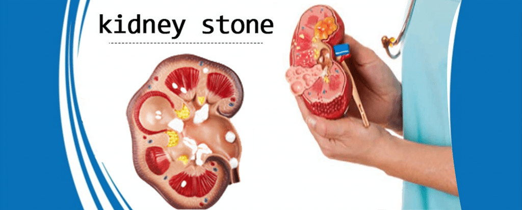 Kidney Stone Symptoms And Right Treatment Dr Devendu Shah