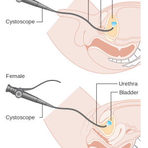 1200px-Diagram_showing_a_cystoscopy_for_a_man_and_a_woman_CRUK_064.svg