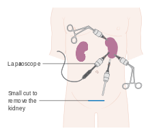 220px-Diagram_showing_laparoscopic_surgery_for_kidney_cancer_CRUK_165.svg