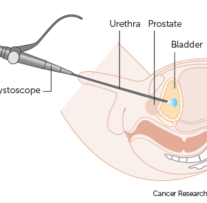 Diagram-showing-a-cystoscopy-for-a-man-using-a-straight-Urethra