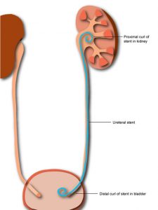 bilateral dj stent nedir