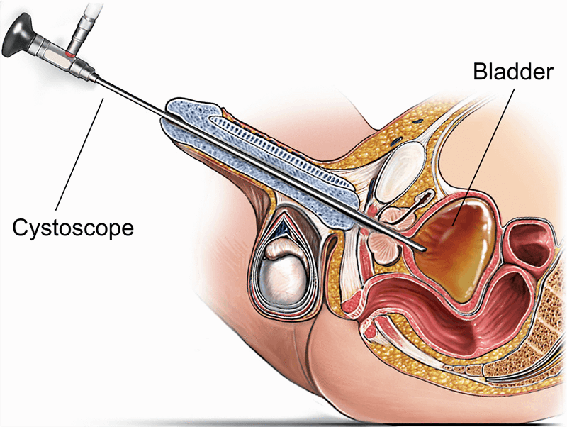 rigid-cystoscopy-male-illustration-de7e6f
